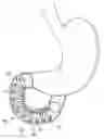 Fig. 01 - DUODENUM SLEEVE FOR TREATING OBESITY