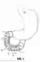 Fig. 02 - DUODENUM SLEEVE FOR TREATING OBESITY