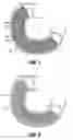 Fig. 05 - DUODENUM SLEEVE FOR TREATING OBESITY