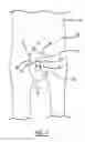 Fig. 02 - ENHANCED MALE PROPHYLACTIC SHIELD