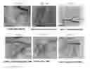 Fig. 07 - Nanocapsule containing a bioactive compound, and a method of reducing toxicity resulting from cancer therapy