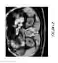 Fig. 04 - Hapten-enhanced chemoimmunotherapy by ultra-minimum incision personalized intratumoral chemoimmunotherapy
