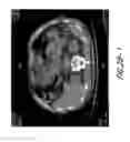 Fig. 06 - Hapten-enhanced chemoimmunotherapy by ultra-minimum incision personalized intratumoral chemoimmunotherapy