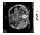Fig. 07 - Hapten-enhanced chemoimmunotherapy by ultra-minimum incision personalized intratumoral chemoimmunotherapy