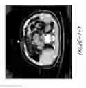 Fig. 08 - Hapten-enhanced chemoimmunotherapy by ultra-minimum incision personalized intratumoral chemoimmunotherapy