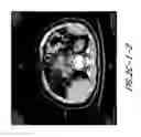 Fig. 09 - Hapten-enhanced chemoimmunotherapy by ultra-minimum incision personalized intratumoral chemoimmunotherapy