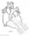Fig. 09 - Implantable pump system having a coaxial ventricular cannula