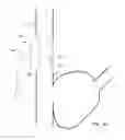 Fig. 40 - Systems and methods for selectively occluding the superior vena cava for treating heart conditions