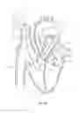 Fig. 43 - Systems and methods for selectively occluding the superior vena cava for treating heart conditions