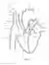 Fig. 45 - Systems and methods for selectively occluding the superior vena cava for treating heart conditions