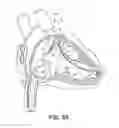 Fig. 06 - Compact implantable medical device and delivery device
