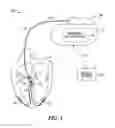 Fig. 02 - Systems and methods for correcting cardiac conduction abnormality using his-bundle pacing
