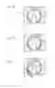 Fig. 09 - Cannula with proximally mounted camera and transparent obturator