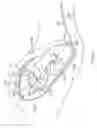 Fig. 07 - Intrauterine balloon apparatus, system, and method for augmenting uterine birthing forces during parturition