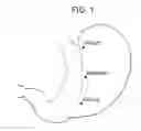 Fig. 02 - Anvil assembly for use with surgical stapling instruments