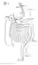 Fig. 03 - Incisionless gastric bypass system