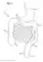 Fig. 05 - Incisionless gastric bypass system