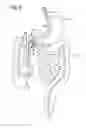 Fig. 08 - Incisionless gastric bypass system