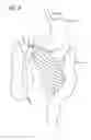 Fig. 09 - Incisionless gastric bypass system
