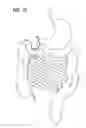 Fig. 10 - Incisionless gastric bypass system