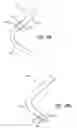 Fig. 25 - Incisionless gastric bypass system
