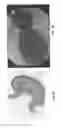 Fig. 05 - Systems and methods for endoscopic submucosal dissection using magnetically attachable clips