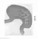Fig. 06 - Systems and methods for endoscopic submucosal dissection using magnetically attachable clips