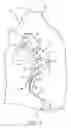 Fig. 02 - ENDOVASCULAR PULSATION BALLOON