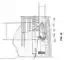 Fig. 08 - Interlocking loop coupling/decoupling system for deploying vascular implant devices