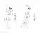 Fig. 08 - Endovascular occlusion device with hemodynamically enhanced sealing and anchoring