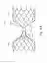 Fig. 41 - Endovascular occlusion device with hemodynamically enhanced sealing and anchoring