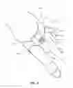 Fig. 09 - Hemostasis devices and methods of use
