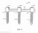 Fig. 04 - Spinal rod implant extension