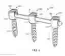 Fig. 05 - Spinal rod implant extension