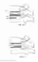 Fig. 06 - EXPANDABLE ARTICULATING INTERVERTEBRAL IMPLANT WITH LIMITED ARTICULATION