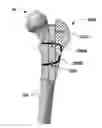 Fig. 01 - Flexible construct for femoral reconstruction