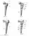 Fig. 07 - Flexible construct for femoral reconstruction