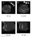 Fig. 09 - Immunotherapeutic methods using irreversible electroporation