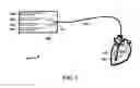 Fig. 02 - Systems and methods for coronary occlusion treatment