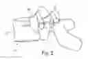 Fig. 03 - Determining an optimal placement of a pedicle screw