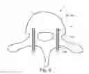 Fig. 07 - Determining an optimal placement of a pedicle screw