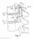 Fig. 08 - Determining an optimal placement of a pedicle screw