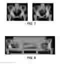 Fig. 09 - Surgical navigation of the hip using fluoroscopy and tracking sensors