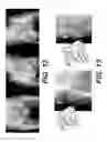 Fig. 11 - Surgical navigation of the hip using fluoroscopy and tracking sensors