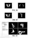Fig. 16 - Surgical navigation of the hip using fluoroscopy and tracking sensors