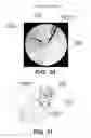 Fig. 22 - Surgical navigation of the hip using fluoroscopy and tracking sensors