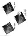 Fig. 28 - Surgical navigation of the hip using fluoroscopy and tracking sensors