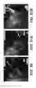Fig. 35 - Surgical navigation of the hip using fluoroscopy and tracking sensors