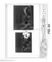 Fig. 37 - Surgical navigation of the hip using fluoroscopy and tracking sensors