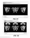 Fig. 40 - Surgical navigation of the hip using fluoroscopy and tracking sensors